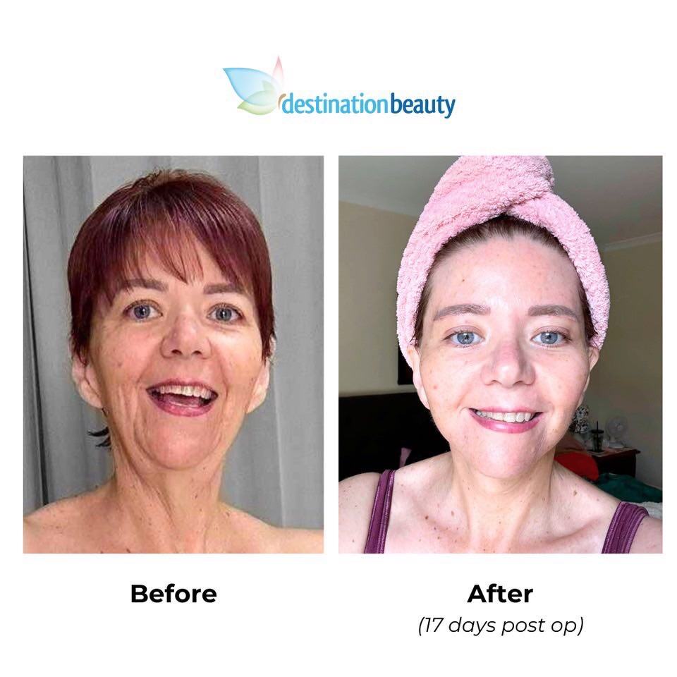 Tanias 17 days post-facelift thailand